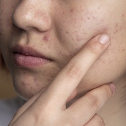 Why More & More People Are Experiencing Sensitive Skin  